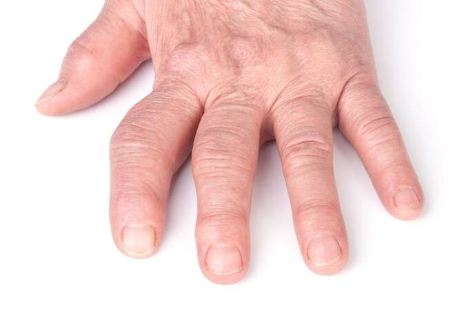 deformierende Arthrose an den Händen