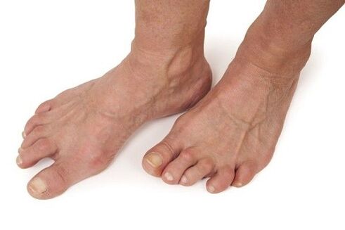 von Arthrose betroffene Füße