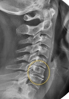 Verengung des Zwischenwirbelraums in der Radiographie
