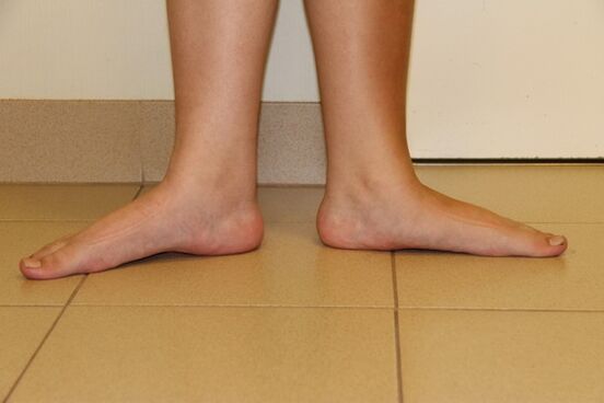 Manchmal sind Plattfüße die Ursache für Nackenarthritis