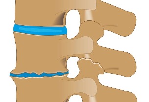 Schädigung der Bandscheibe mit Osteochondrose
