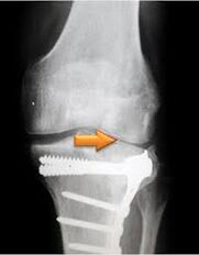 Arthrose des Kniegelenks