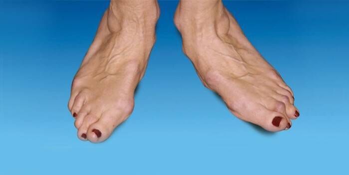 Fußdeformität mit Arthrose des Sprunggelenks